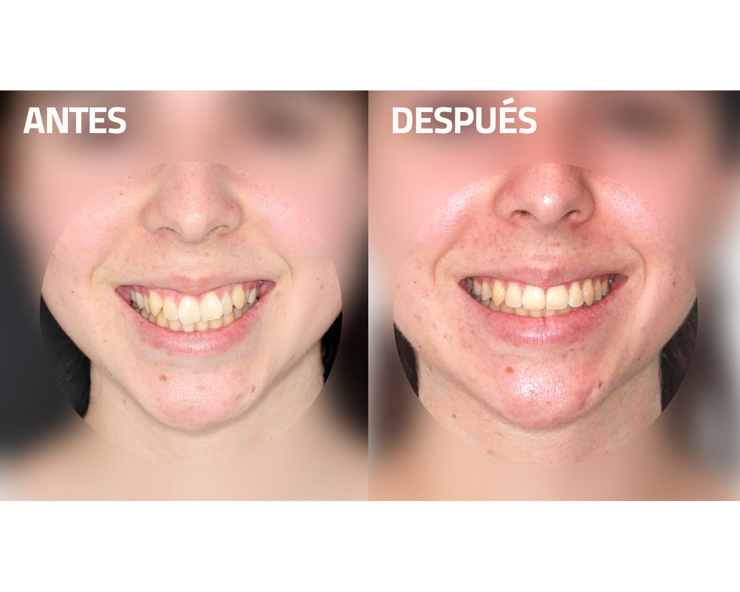 antes y después ortodoncia novasmile
