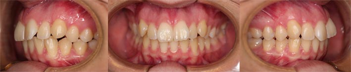 ortodoncia con extracciones