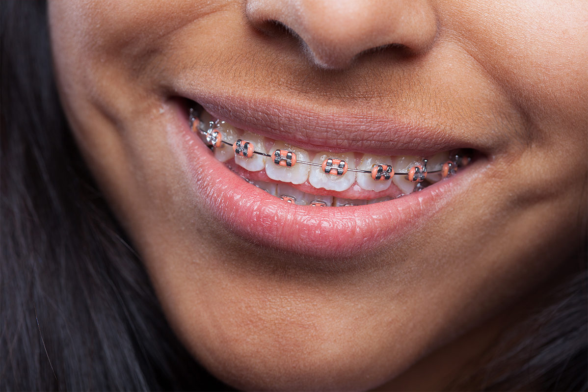 Consejos Para Solucionar Problemas Con Tus Brackets