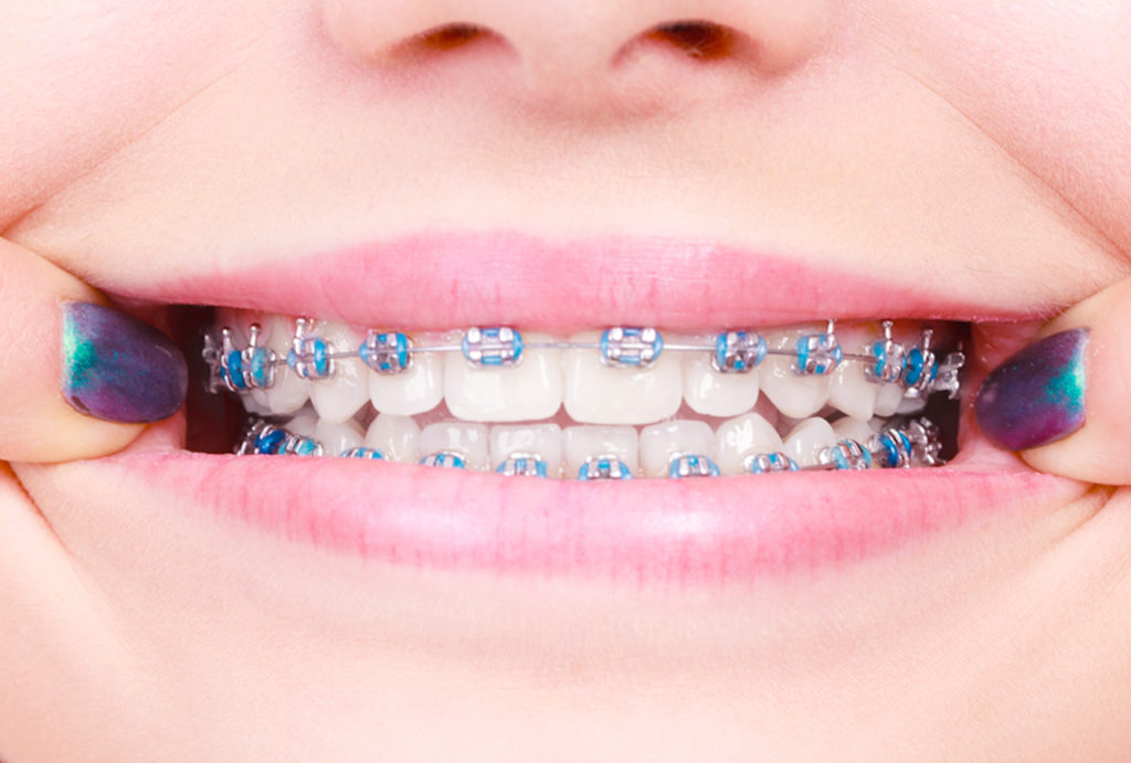 Brackets estéticos cerámicos, con toda la garantía de 3M