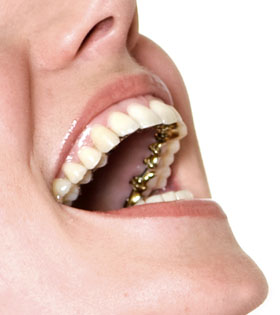 Lingual orthodontics